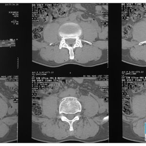 Chấn thương cột sống