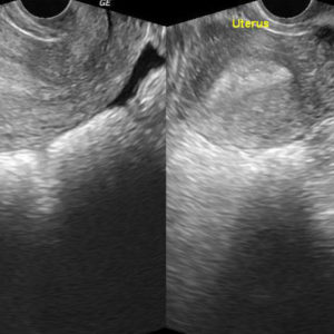 Thai ngoài tử cung