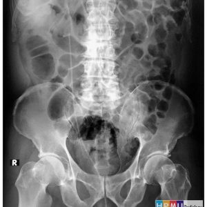 Urinoma