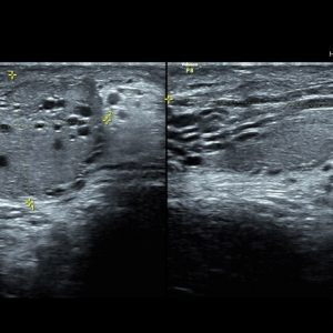 Giãn tĩnh mạch tinh