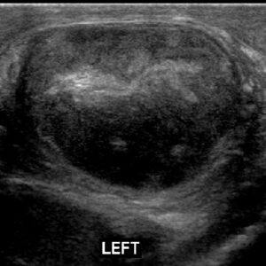 Nhồi máu tinh hoàn