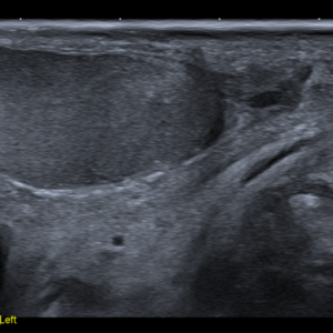 Tinh hoàn trái bình thường