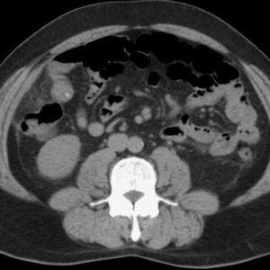 Nhồi máu mạc nối
