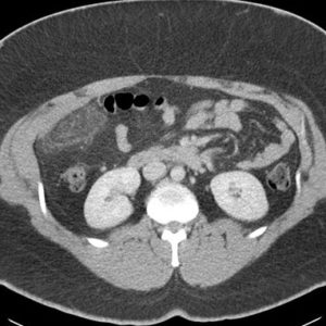 Nhồi máu mạc nối