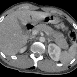 Chấn thương tụy