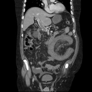 Huyết khối tĩnh mạch MTTT