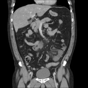 Huyết khối tĩnh mạch MTTT