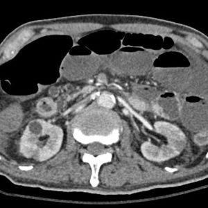 Huyết khối động mạch MTTT