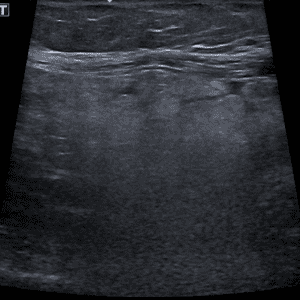 Viêm bờm mỡ đại tràng