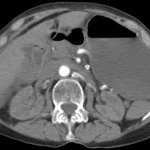 Huyết khối động mạch MTTT