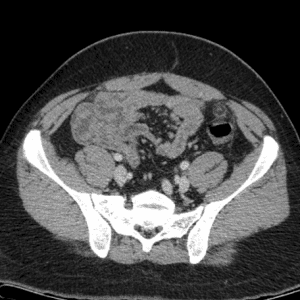 Viêm bờm mỡ đại tràng