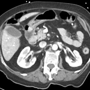 Huyết khối động mạch MTTT