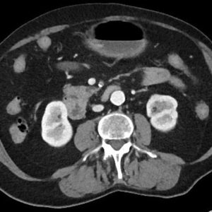 Huyết khối động mạch MTTT