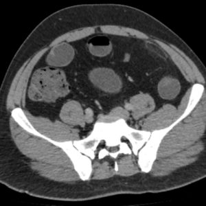 Viêm bờm mỡ đại tràng