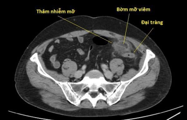 Viêm bờm mỡ