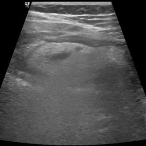 Nhồi máu mạc nối