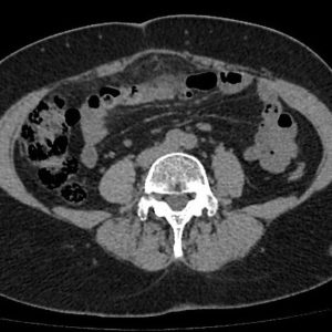 Nhồi máu mạc nối