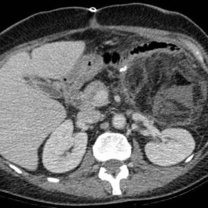 Nhồi máu mạc nối