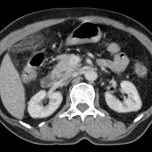 Viêm bờm mỡ đại tràng