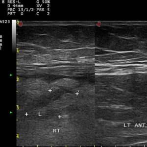 Viêm bờm mỡ đại tràng