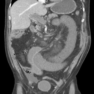 Thiếu máu mạc treo