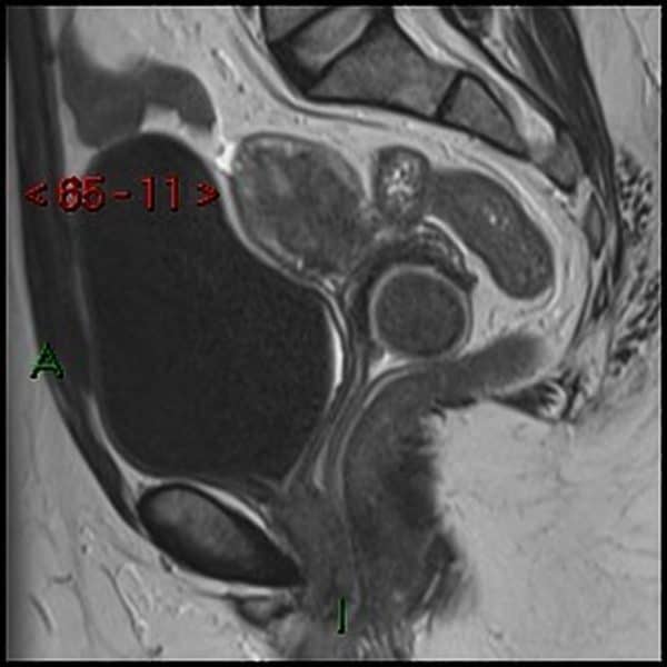 Polyp nội mạc tử cung