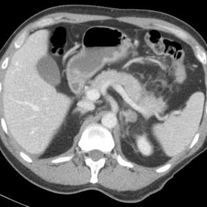 Chấn thương tụy