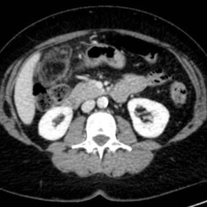 Nhồi máu mạc nối