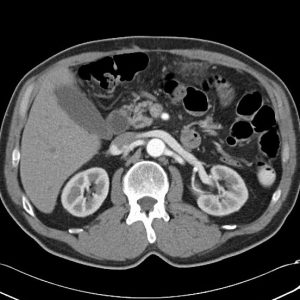 Nhồi máu mạc nối