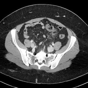 Viêm bờm mỡ đại tràng