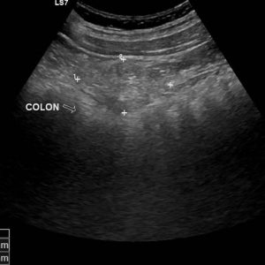 Viêm bờm mỡ đại tràng
