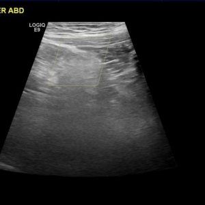 Viêm bờm mỡ đại tràng