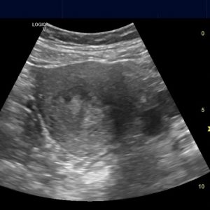 Polyp nội mạc tử cung