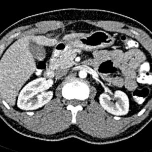 Nhồi máu mạc nối