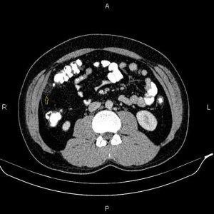 Nhồi máu mạc nối