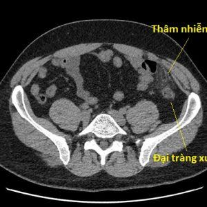 Viêm bờm mỡ đại tràng