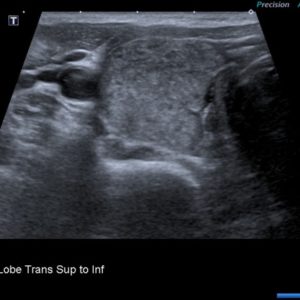 Viêm tuyến giáp Hashimoto