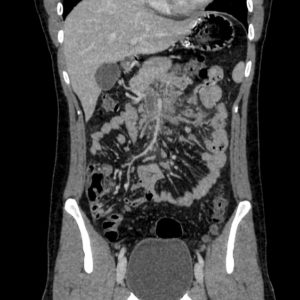 Huyết khối tĩnh mạch MTTT