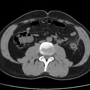 Viêm bờm mỡ đại tràng
