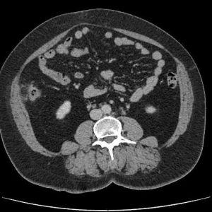 Viêm bờm mỡ đại tràng