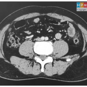 Viêm bờm mỡ đại tràng