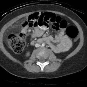 Nhồi máu mạc nối