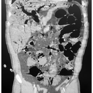 Khí tĩnh mạch cửa