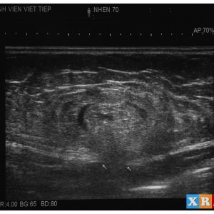 Nhồi máu mạc nối