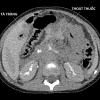 Vỡ tá tràng - Hình ảnh 7