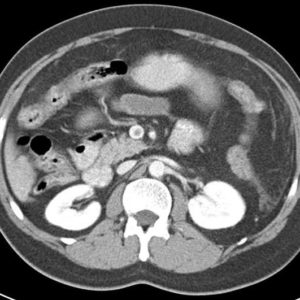 Huyết khối tĩnh mạch MTTT