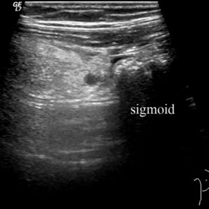 Viêm bờm mỡ đại tràng