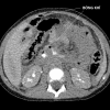 Vỡ tá tràng - Hình ảnh 8
