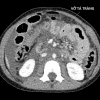 Vỡ tá tràng - Hình ảnh 4
