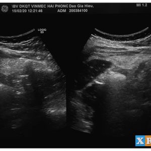 Nhồi máu mạc nối